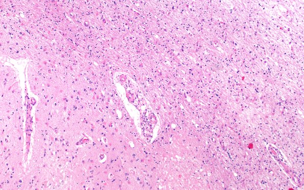 18C8 TREX1 Disease (Case 18) H&E N22 10X