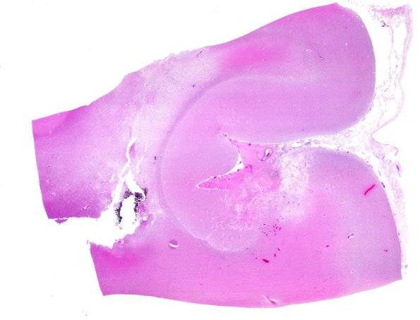 18D1 TREX1 Disease (Case 18) H&E N23 WM