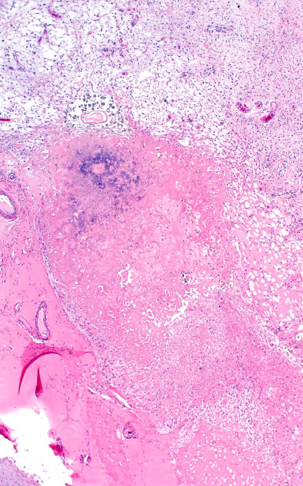 18D3 TREX1 Disease (Case 18) H&E N23 4X