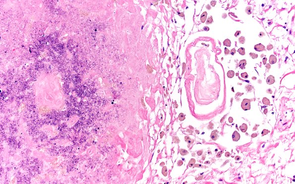 18D4 TREX1 Disease (Case 18) H&E N23 20X