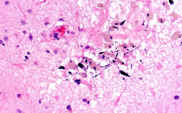 18E3 TREX1 Disease (Case 18) H&E N1 40X 1