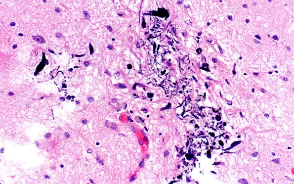 18E4 TREX1 Disease (Case 18) H&E N1 40X 2