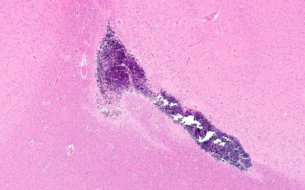 18E5 TREX1 Disease (Case 18) H&E N18 4X 1