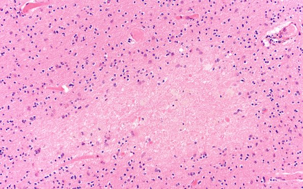 18E6 TREX1 Disease (Case 18) H&E N18 20X 1