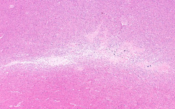 18E7 TREX1 Disease (Case 18) H&E N20 4X 1