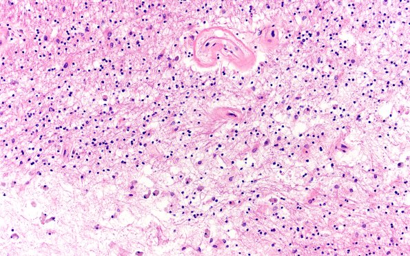 18E8 TREX1 Disease (Case 18) H&E N20 20X 1