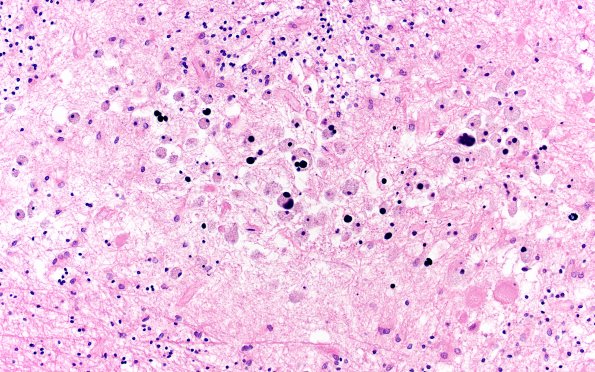 18E9 TREX1 Disease (Case 18) H&E N20 20X 2