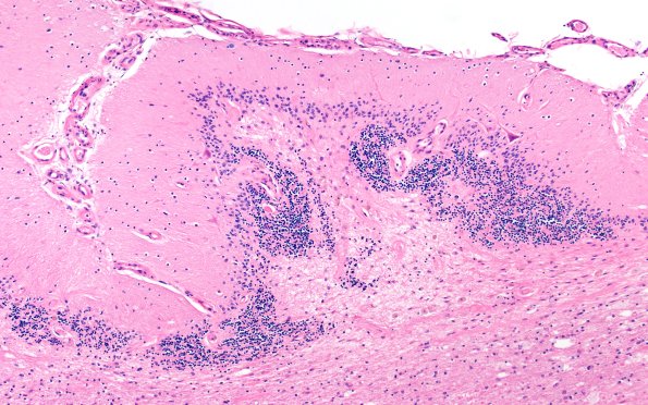 18F3 TREX1 Disease (Case 18) H&E N9 10X 3