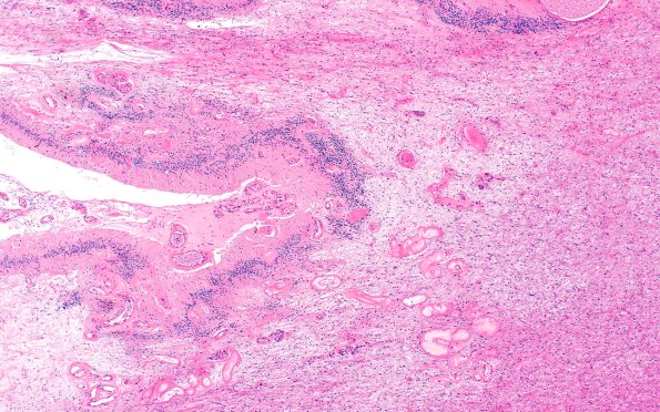 18G2 TREX1 Disease (Case 18) H&E N14 4X 1