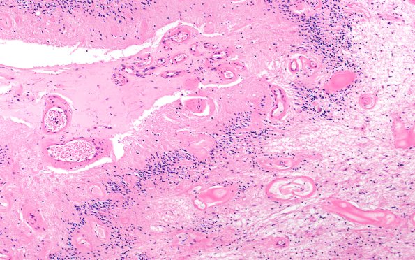 18G3 TREX1 Disease (Case 18) H&E N14 10X 1