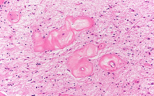 18G5 TREX1 Disease (Case 18) H&E N14 20X 12