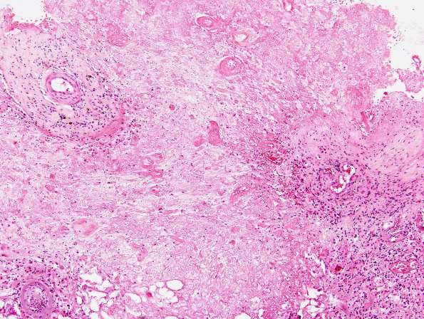 1A1 Cerebroretinal Vasculopathy, CRV, RVCL, TREX, HERNS, Case 1 Surgical) H&E 6a