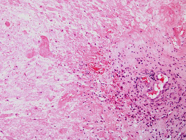 1A2 Cerebroretinal Vasculopathy, CRV, RVCL, TREX, HERNS, Case 1 Surgical) H&E 5