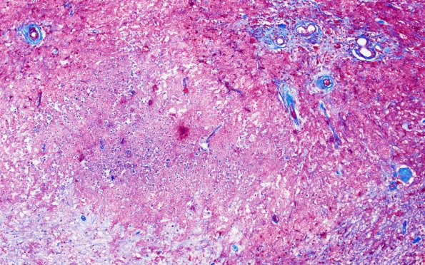 1A6 Cerebroretinal Vasculopathy, CRV, RVCL, TREX, HERNS, Case 1 Surgical) Trichrome 10X