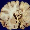 1B1 Cerebroretinal Vasculopathy, CRV, RVCL, TREX, HERNS, Case 1 Autopsy) 2AB