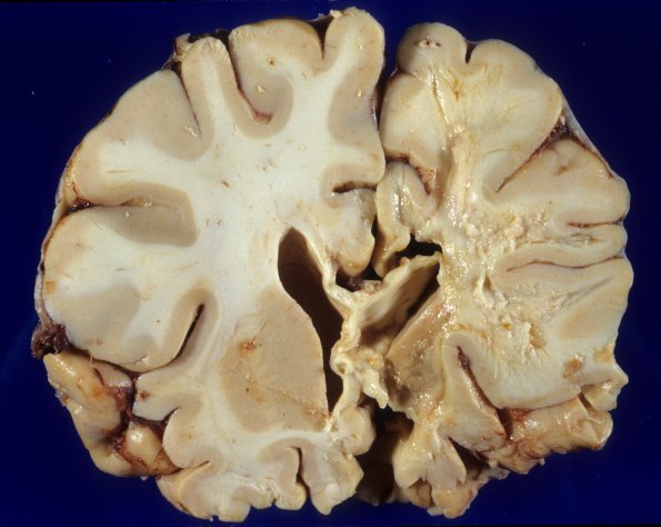 1B1 Cerebroretinal Vasculopathy, CRV, RVCL, TREX, HERNS, Case 1 Autopsy) 2AB