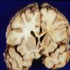 Retinal Vasculopathy with Cerebral Leukoencephalopathy (RVCL, TREX1 Mutation) 