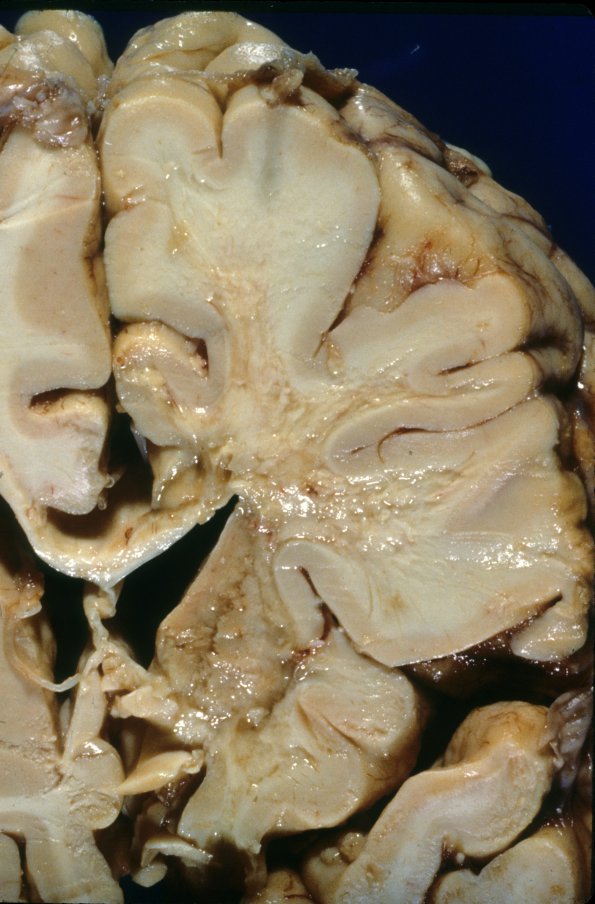 1B3 Cerebroretinal Vasculopathy, CRV, RVCL, TREX, HERNS, Case 1 Autopsy) 2