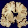 1B4 Cerebroretinal Vasculopathy, CRV, RVCL, TREX, HERNS, Case 1 Autopsy) 4