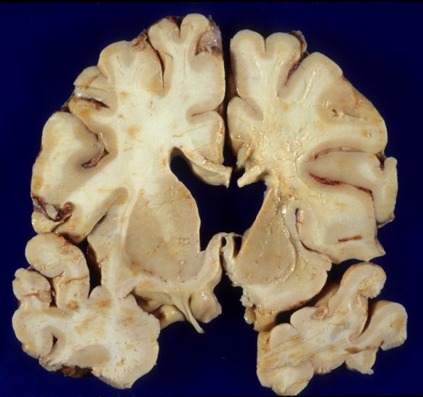 1B4 Cerebroretinal Vasculopathy, CRV, RVCL, TREX, HERNS, Case 1 Autopsy) 4