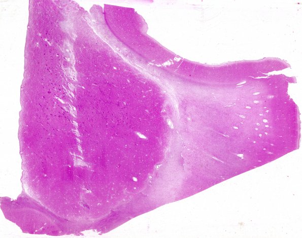 1C1 Cerebroretinal Vasculopathy, CRV, RVCL, TREX, HERNS, Case 1 Autopsy) H&E whole mount 2