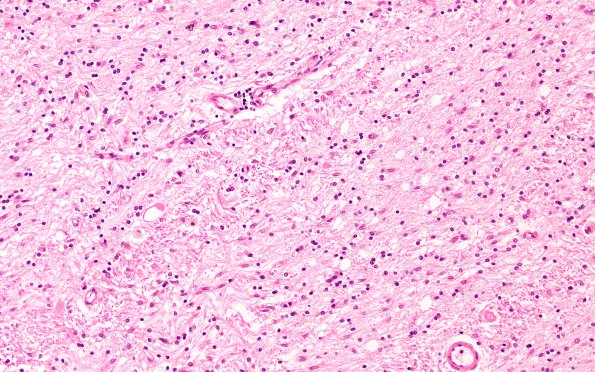 1C2 CRV, TREX (Case 1 Autopsy) N5 H&E