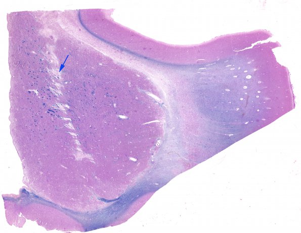 1C3 CRV, TREX (Case 1 Autopsy) N3 LFB-PAS WM copy