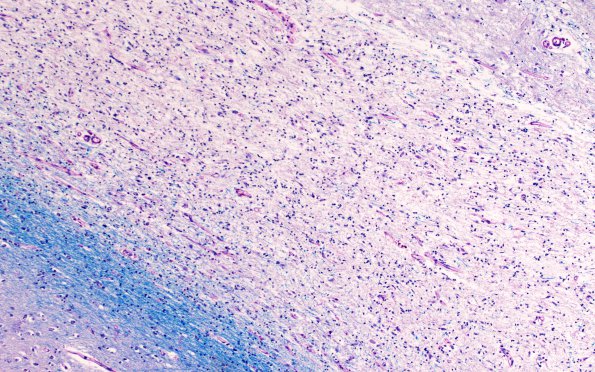 1C4 CRV, TREX (Case 1 Autopsy) N3 LFB-PAS WM 10X