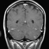 2A1 Cerebroretinal vasculopathy (AKA  = CRV, RVCL, TREX, HERNS, Case 2) 2005 T1 W 1 - Copy