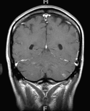 2A1 Cerebroretinal vasculopathy (AKA  = CRV, RVCL, TREX, HERNS, Case 2) 2005 T1 W 1 - Copy