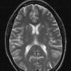 2A2 Cerebroretinal vasculopathy (AKA  = CRV, RVCL, TREX, HERNS, Case 2) 2006 TSE T2 - Copy