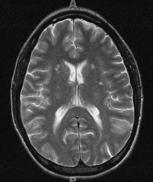 2A2 Cerebroretinal vasculopathy (AKA  = CRV, RVCL, TREX, HERNS, Case 2) 2006 TSE T2 - Copy