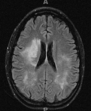 2A3 Cerebroretinal vasculopathy (AKA  = CRV, RVCL, TREX, HERNS, Case 2) 2008 T2 FLAIR 2 - Copy