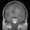 2A4 Cerebroretinal vasculopathy (AKA  = CRV, RVCL, TREX, HERNS, Case 2) 2008 T1 W 3 - Copy