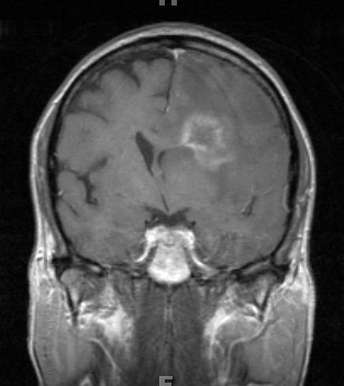 2A4 Cerebroretinal vasculopathy (AKA  = CRV, RVCL, TREX, HERNS, Case 2) 2008 T1 W 3 - Copy