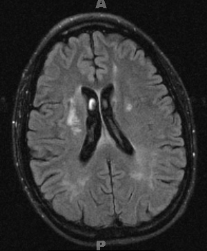 2A5 Cerebroretinal vasculopathy (AKA  = CRV, RVCL, TREX, HERNS, Case 2) 2009 T2 FLAIR 3 - Copy