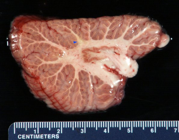 2B3 Cerebroretinal Vasculopathy ( Case 2) 1_14 copy