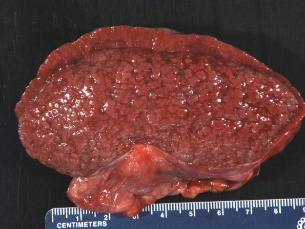 2C1 Cerebroretinal Vasculopathy (Case 2) 1_17