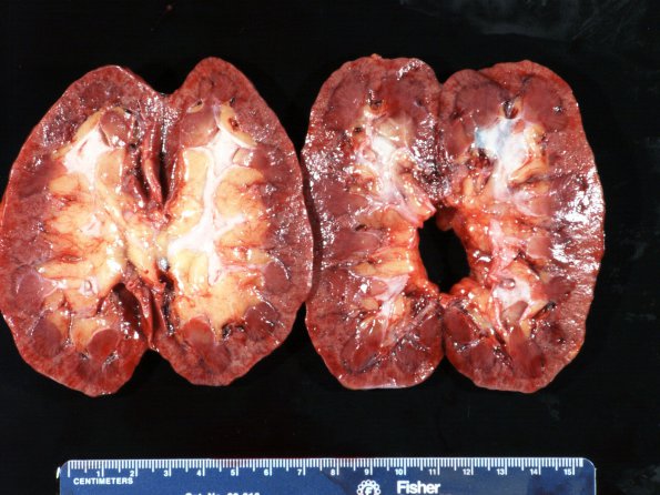 2C2 Cerebroretinal Vasculopathy ( Case 2) 1_2