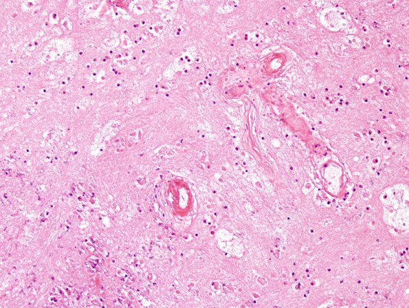 2D3 Cerebroretinal Vasculopathy, CRV, RVCL, TREX, HERNS, Case 2) H&E 2