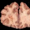 3A1 Cerebroretinal Vasculopathy (CRV, TREX, HERNS, Case 3)_3