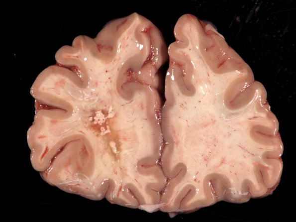 3A1 Cerebroretinal Vasculopathy (CRV, TREX, HERNS, Case 3)_3