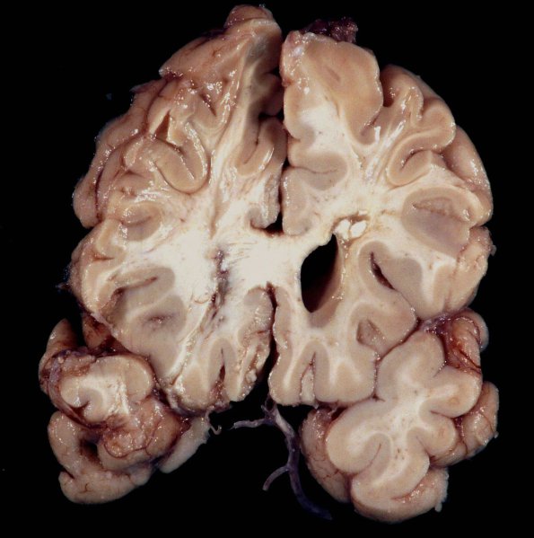 3A2 Cerebroretinal Vasculopathy (CRV, TREX, HERNS, Case 3)_8