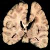 3A4 Cerebroretinal Vasculopathy (CRV, TREX, HERNS, Case 3)_13redo