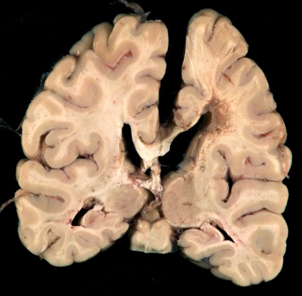 3A4 Cerebroretinal Vasculopathy (CRV, TREX, HERNS, Case 3)_13redo