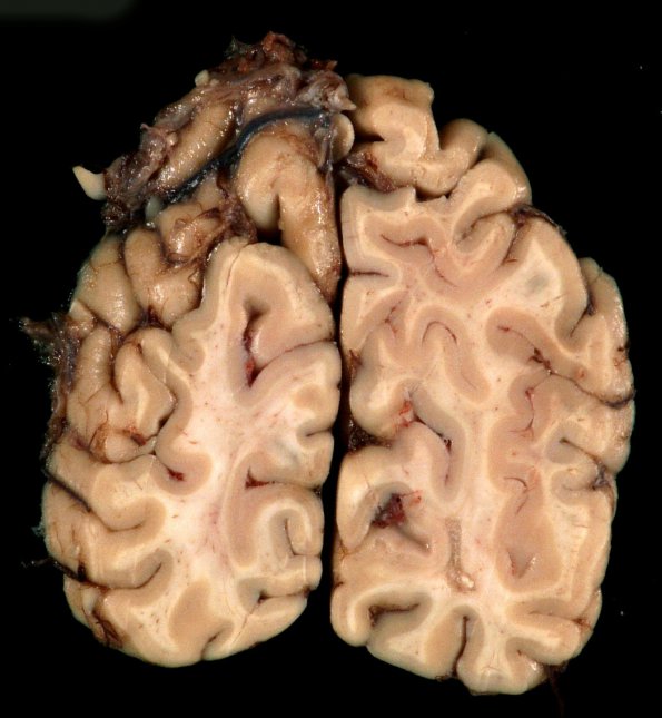 3A6 Cerebroretinal Vasculopathy (CRV, TREX, HERNS, Case 3)_21