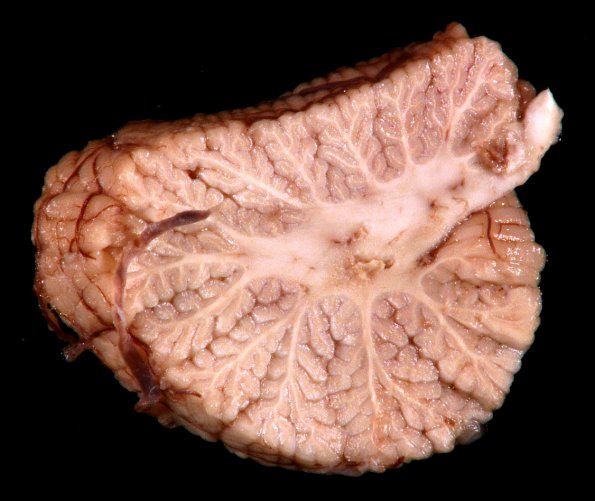 3A8 Cerebroretinal Vasculopathy (CRV, TREX, HERNS, Case 3)_27