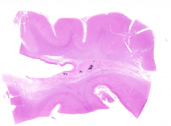 3B1 Cerebroretinal Vasculopathy (CRV, TREX, HERNS, Case 3) N17 H&E whole mount