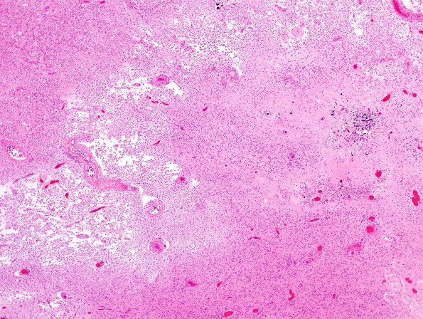 3B3 Cerebroretinal Vasculopathy (CRV, TREX, HERNS, Case 3) N16 H&E 1