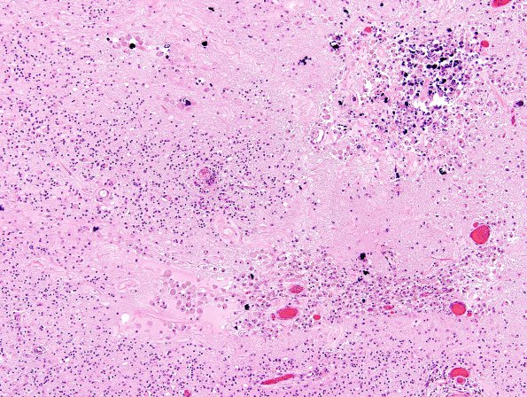 3B4 Cerebroretinal Vasculopathy (CRV, TREX, HERNS, Case 3) N16 H&E 3